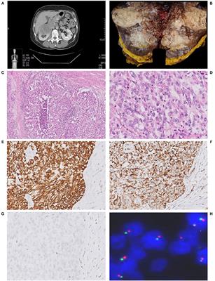 Case Report: Unclassified Renal Cell Carcinoma With Medullary Phenotype and SMARCB1/INI1 Deficiency, Broadening the Spectrum of Medullary Carcinoma